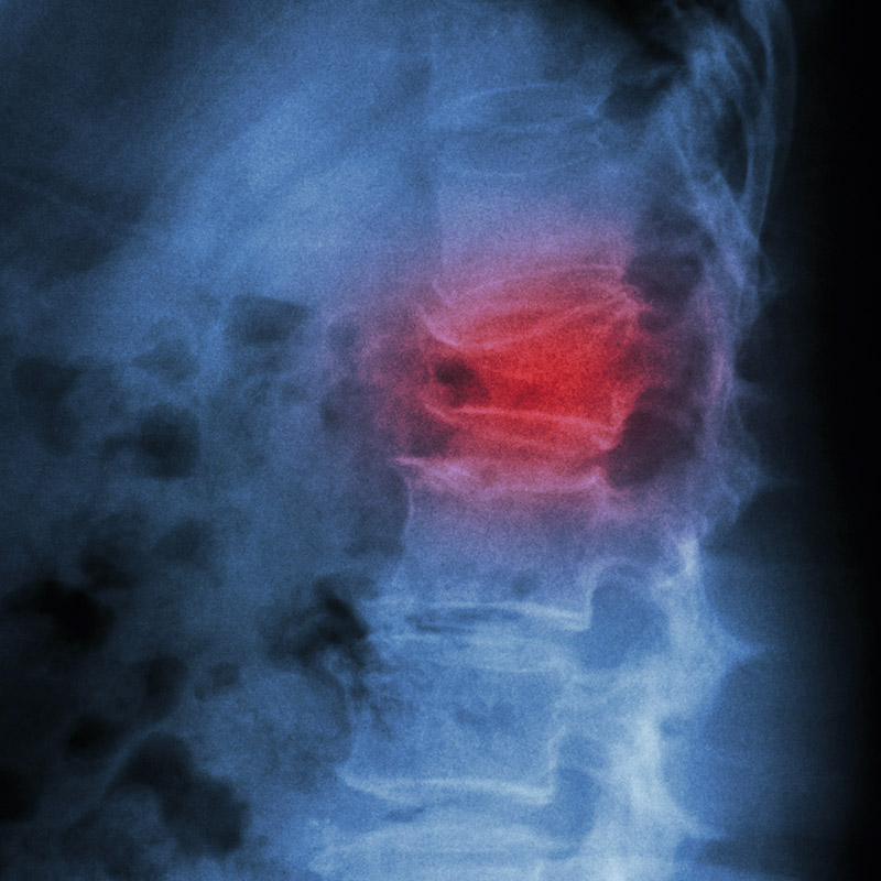 dr. chintan sampat treats Spondylolysis & Spondylolisthesis