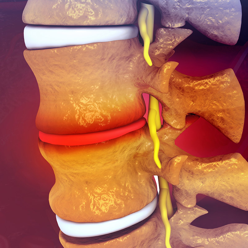 dr. chintan sampat treats degenerative disc disease