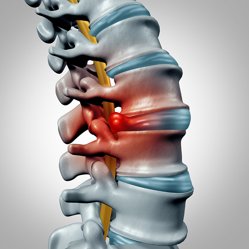 dr. chintan sampat treats herniated discs