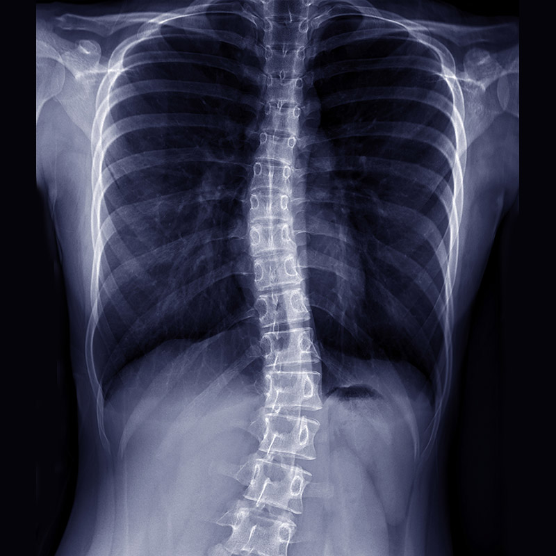 dr. chintan sampat treats scoliosis