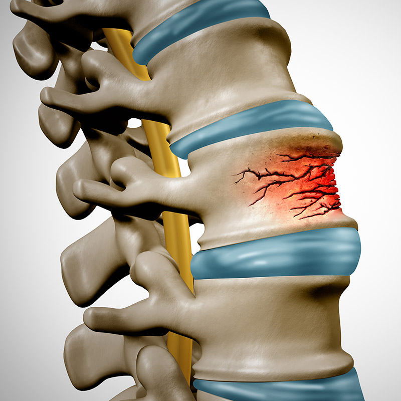 dr. chintan sampat treats spinal fractures