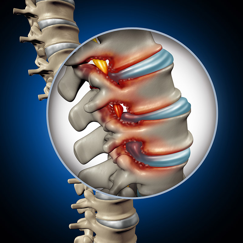 dr. chintan sampat treats spinal stenosis